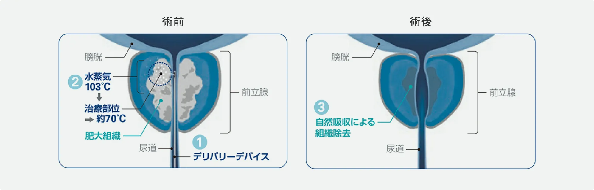 WAVE（経尿道的水蒸気治療）の術前・術後の前立腺の状態を表した図解