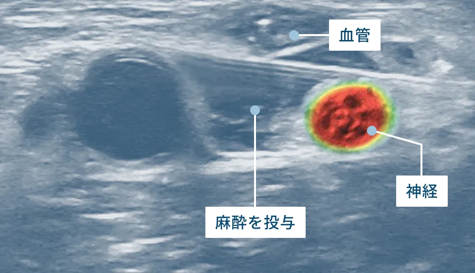 局所麻酔