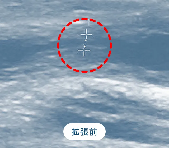 バルーン拡張 拡張前
