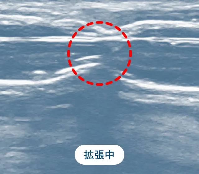 バルーン拡張 拡張中