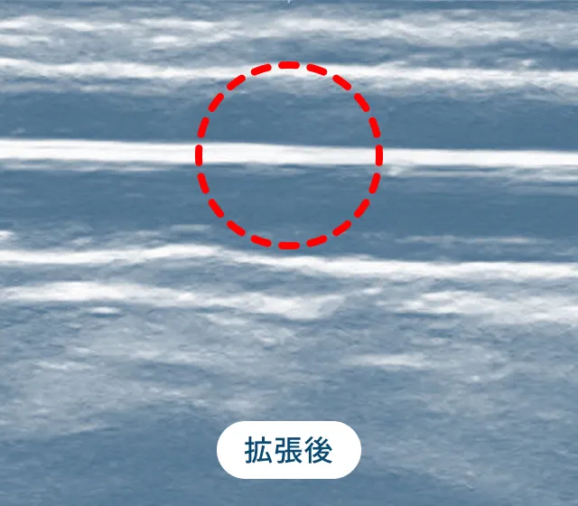 バルーン拡張 拡張後